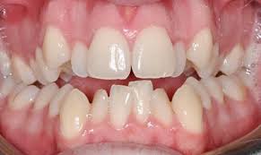 Veneer