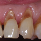 Veneer