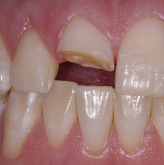 Veneer