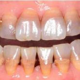 Veneer